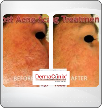 hair transplant results