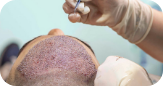 HAIR TRANSPLANTATION