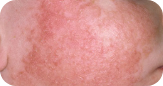 Skin Concerns