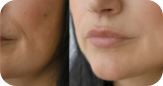 Laser Resurfacing for Acne Scar
