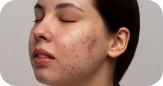 Acne Scar