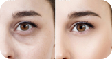 Under eye treatment