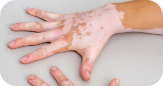 Vitiligo
