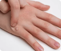 Wart Lifestyle